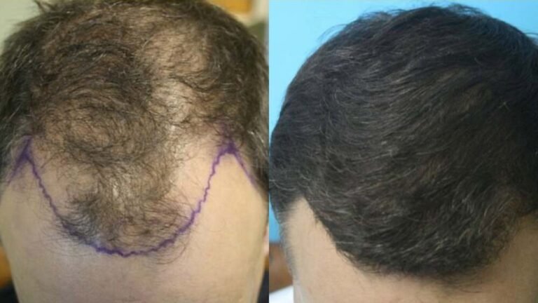 Effective Ways to Approach Hair Transplantation for a Fuller Hairline