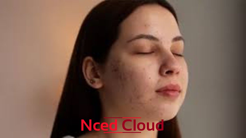 Top 15 Home Remedies to Cure Open Pores on Face & - Tymoff